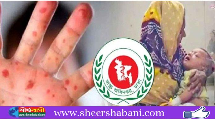 হাম ও হামের উপসর্গ নিয়ে ১৬ জনের মৃত্যু