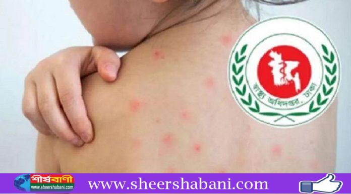 হামের উপসর্গে আরও ৪ মৃত্যু, ভর্তি ১,০১৮