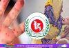 হাম-উপসর্গে ৪ মৃত্যু, আক্রান্ত ৮৪৩