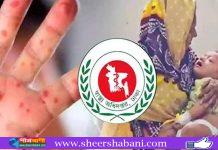 হাম-উপসর্গে ৪ মৃত্যু, আক্রান্ত ৮৪৩