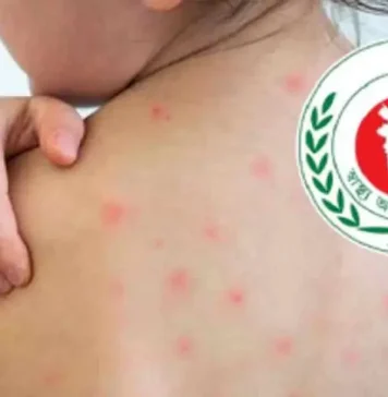 হামের উপসর্গে আরও ৪ জনের মৃত্যু, আক্রান্ত ১২৩৬