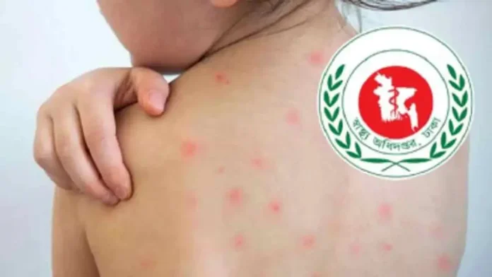 measles-20260920163239